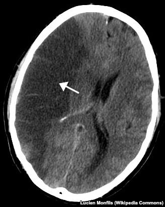 Изображение поврежденного участка мозга, полученное методом компьютерной томографии
