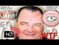 Незрячий мужчина впервые увидел свою жену, когда ему вставили в глаз часть зуба