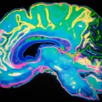 Корейские ученые успешно испытали лекарство от болезни Альцгеймера