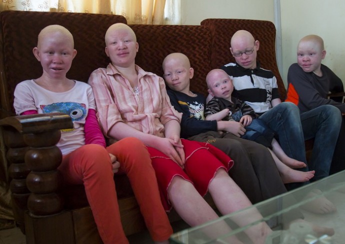 Приют для детей-альбиносов